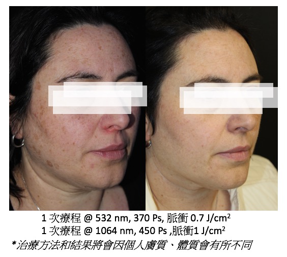 pico laser tattoo removal